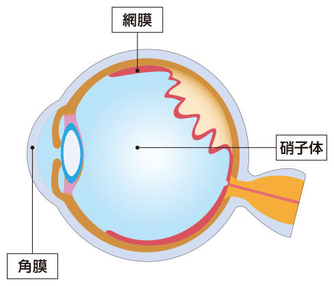 【兵庫医科大学】～網膜剥離 手術後～ 眼球内にシワが存在、視界のゆがみの原因に